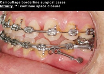 Micro-implant or mini-implant IOS
